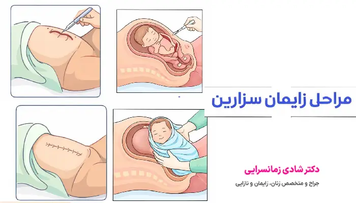 مراحل زایمان سزارین