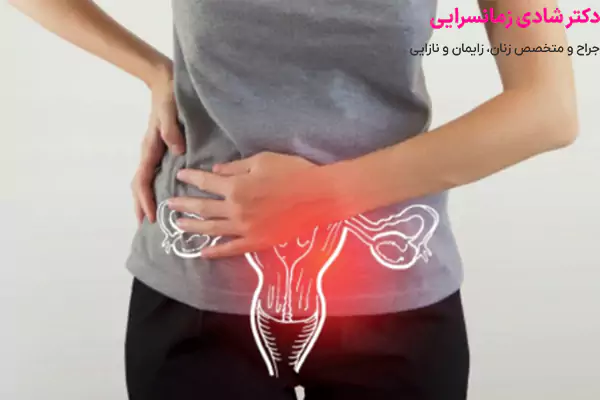 علائم کیست تخمدان