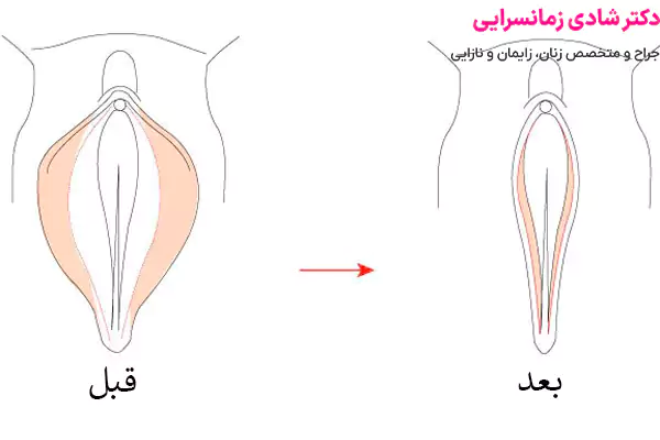 دوره نقاهت لابیاپلاستی
