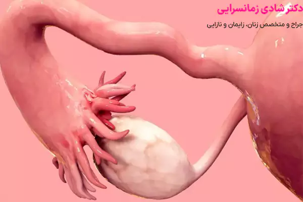 پیشگیری از کیست تخمدان