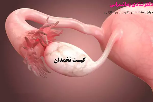 کیست تخمدان چیست